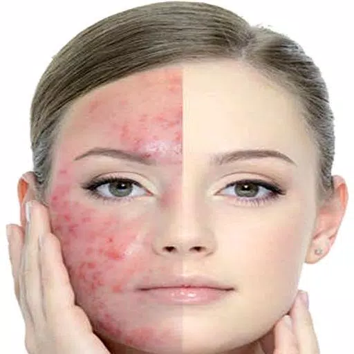 Get Rid of Acne  (Guide)应用截图第1张